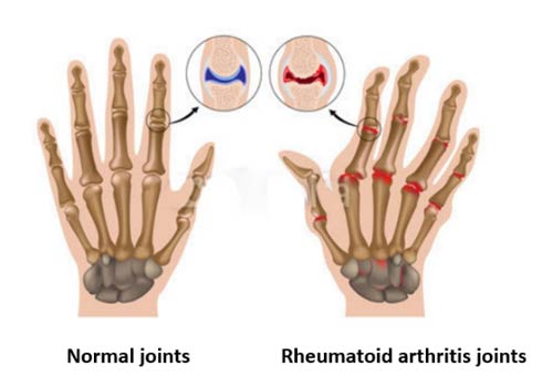 Anti-CCP, A Signal Lamp For Rheumatoid Arthritis