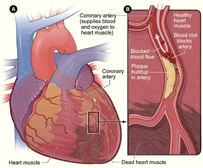 Myoglobin Testing in Cardiovascular Testing